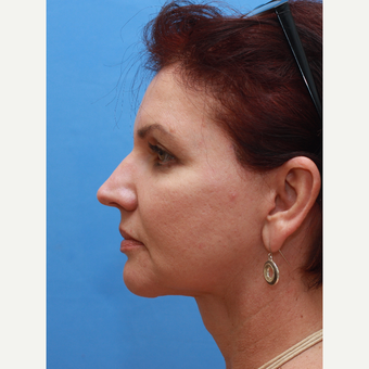 Lady underwent a neck lift after 3372819