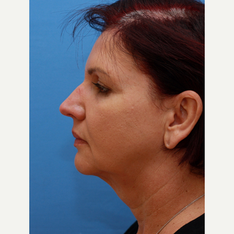 Lady underwent a neck lift before 3372819