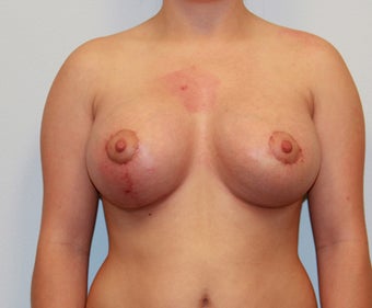 Dual Plane III (submuscular) Augmentation and Mastopexy (Circumareolar on left, Circumvertical on Right) after 932597