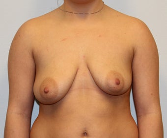 Dual Plane III (submuscular) Augmentation and Mastopexy (Circumareolar on left, Circumvertical on Right) before 932597
