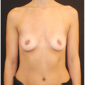 35-44 year old woman treated with Breast Implants before 1687141