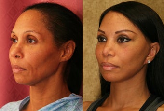 African Americn Rhinoplasty 967905