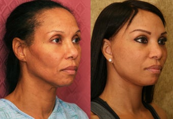 African Americn Rhinoplasty after 967905