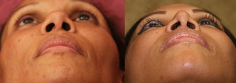 African Americn Rhinoplasty before 967905