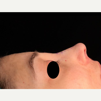18-24 year old woman treated with Rhinoplasty after 3211848