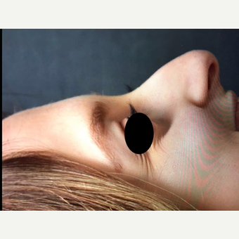 18-24 year old woman treated with Rhinoplasty before 3211848