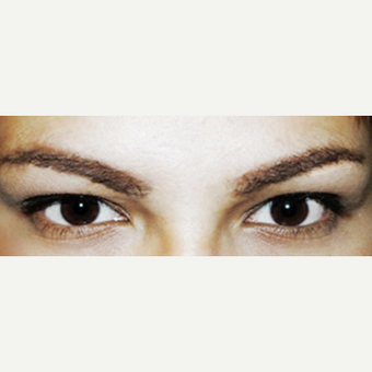 25-34 year old woman treated with Eyebrow Transplant after 3420778
