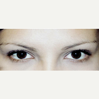 25-34 year old woman treated with Eyebrow Transplant before 3420778