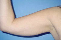 Arm Liposuction before 652128