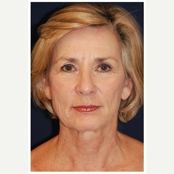 55-64 year old woman treated with Cheek Lift before 1550678