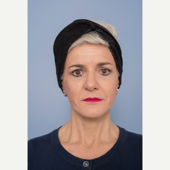55-64 year old woman treated with Facelift after 3329009