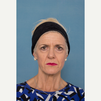 55-64 year old woman treated with Facelift before 3329009