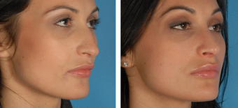 Revision Rhinoplasty before 1208283