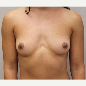 27 year old woman treated with Breast Augmentation before 3689567