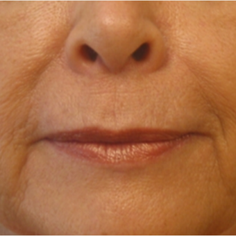 Rejuvenation using Juvederm on 65 year old patient after 2276293