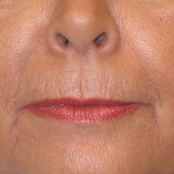 Rejuvenation using Juvederm on 65 year old patient before 2276293