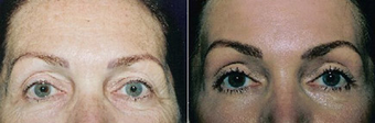 Chemical Peel before 1431804