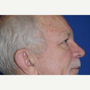 Eyelid Surgery after 3744048