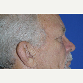 Eyelid Surgery before 3744048
