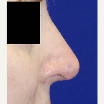 45-54 year old woman treated with Revision Rhinoplasty after 2122077