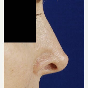 45-54 year old woman treated with Revision Rhinoplasty before 2122077