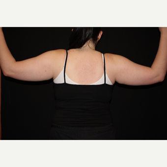 25-34 year old woman treated with Arm Liposuction before 3186595