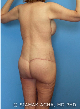 High-Definition™ Total Body Lift after 177430
