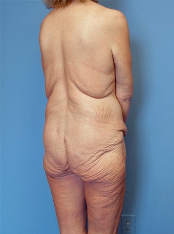High-Definition™ Total Body Lift before 177430