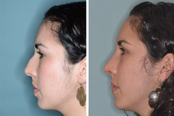 Post-Op Female Rhinoplasty and Septoplasty before 1413631