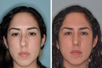 Post-Op Female Rhinoplasty and Septoplasty 1413631