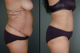 Pure Tumescent Liposuction before 996398