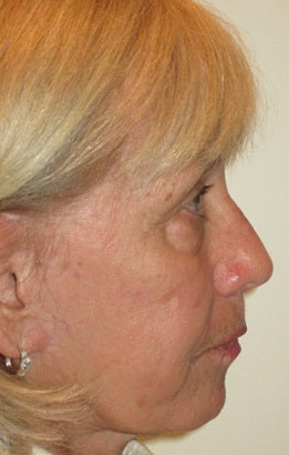 Upper and lower lid blepharoplasty, chemical peel to lower lids before 875969