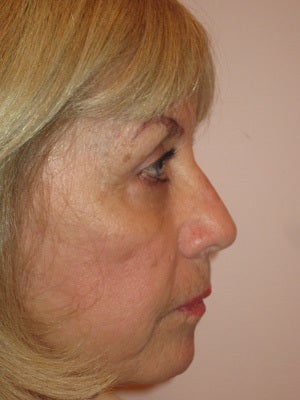 Upper and lower lid blepharoplasty, chemical peel to lower lids after 875969