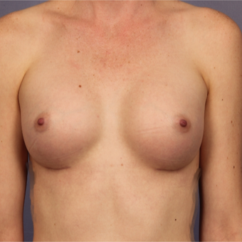Breast implants after 3646869