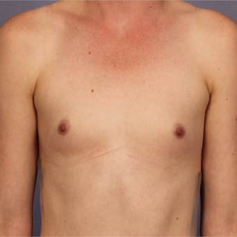 Breast implants before 3646869