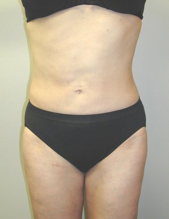 SmartLipo after 607527