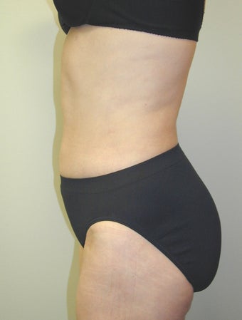 SmartLipo 607527