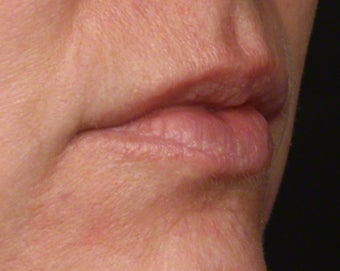 35-44 year old woman treated with Volbella 3804642