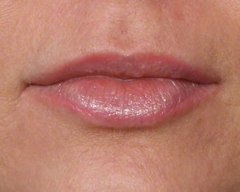 35-44 year old woman treated with Volbella after 3804642