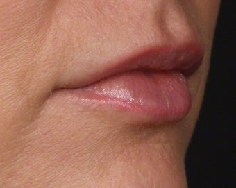 35-44 year old woman treated with Volbella 3804642