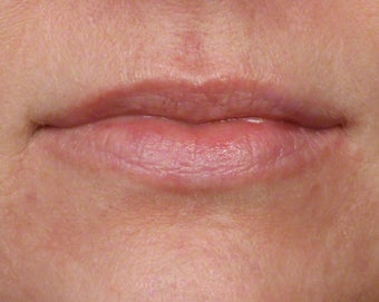 35-44 year old woman treated with Volbella before 3804642