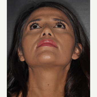 25-34 year old woman treated with Rhinoplasty 10 days post-op after 3452308