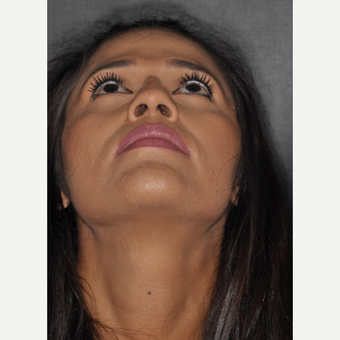 25-34 year old woman treated with Rhinoplasty 10 days post-op before 3452308