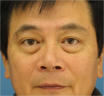 Blepharoplasty, Eyelid Surgery before 425003