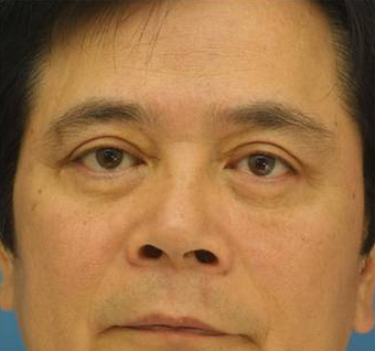 Blepharoplasty, Eyelid Surgery after 425003