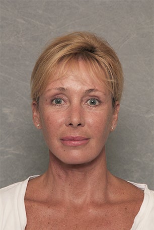 Neck Lift - 52 Year Old Female after 1392503
