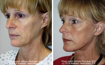 Dermabrasion before 1385309
