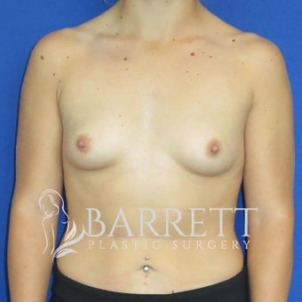 18-24 year old woman treated with Breast Augmentation before 2499342