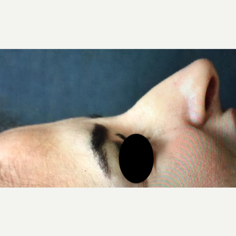 35-44 year old woman treated with Rhinoplasty before 3211288