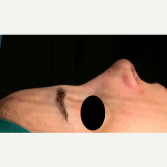 35-44 year old woman treated with Rhinoplasty after 3211288